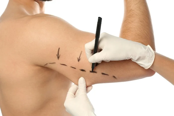 Hae your upper arm reshaped with Brachioplasty from one of the best plastic surgeons in Minnesota